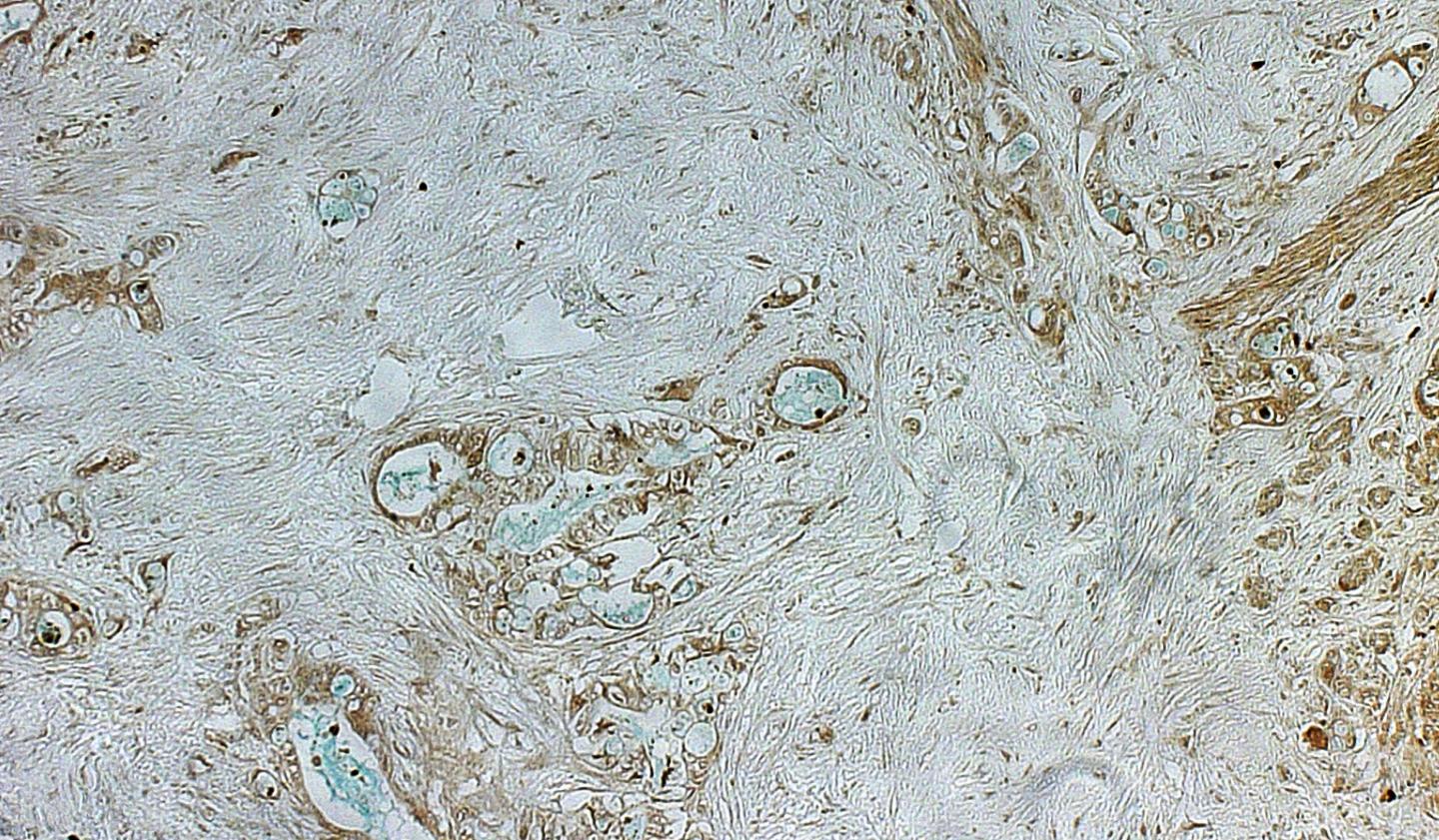 Image of pancreatic cancer histology under the microscope.