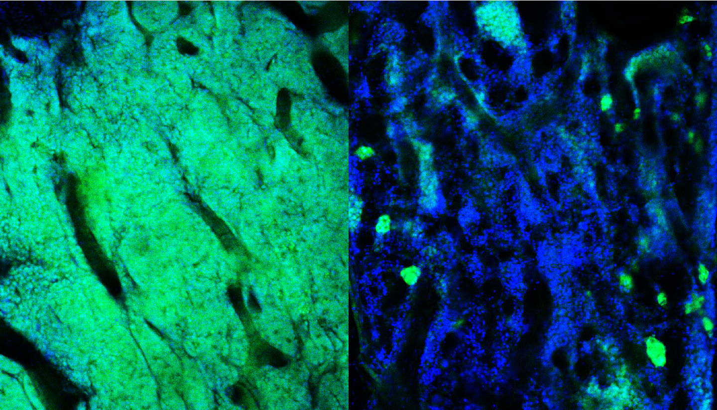 Microscopy image of leukemia cells.
