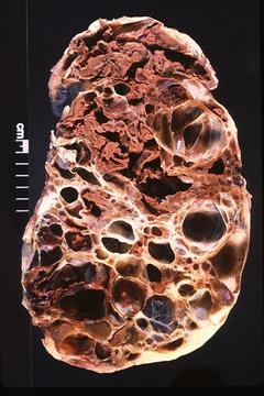 Adult_Polycystic_Kidney.jpg