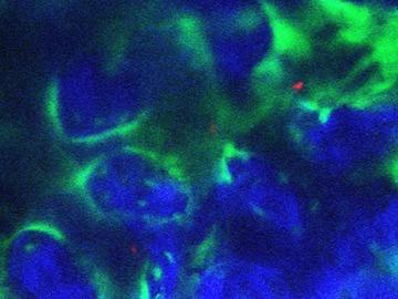 SLD-Scadden-leukemia-360x270.jpg