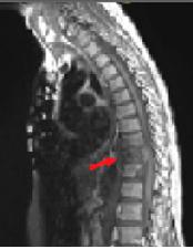 spine involvement