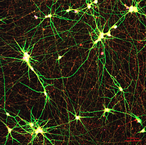 New brain model sheds patient-specific light on Alzheimer's