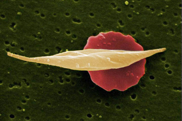 Researchers find sickle cell disease's Achilles' heel
